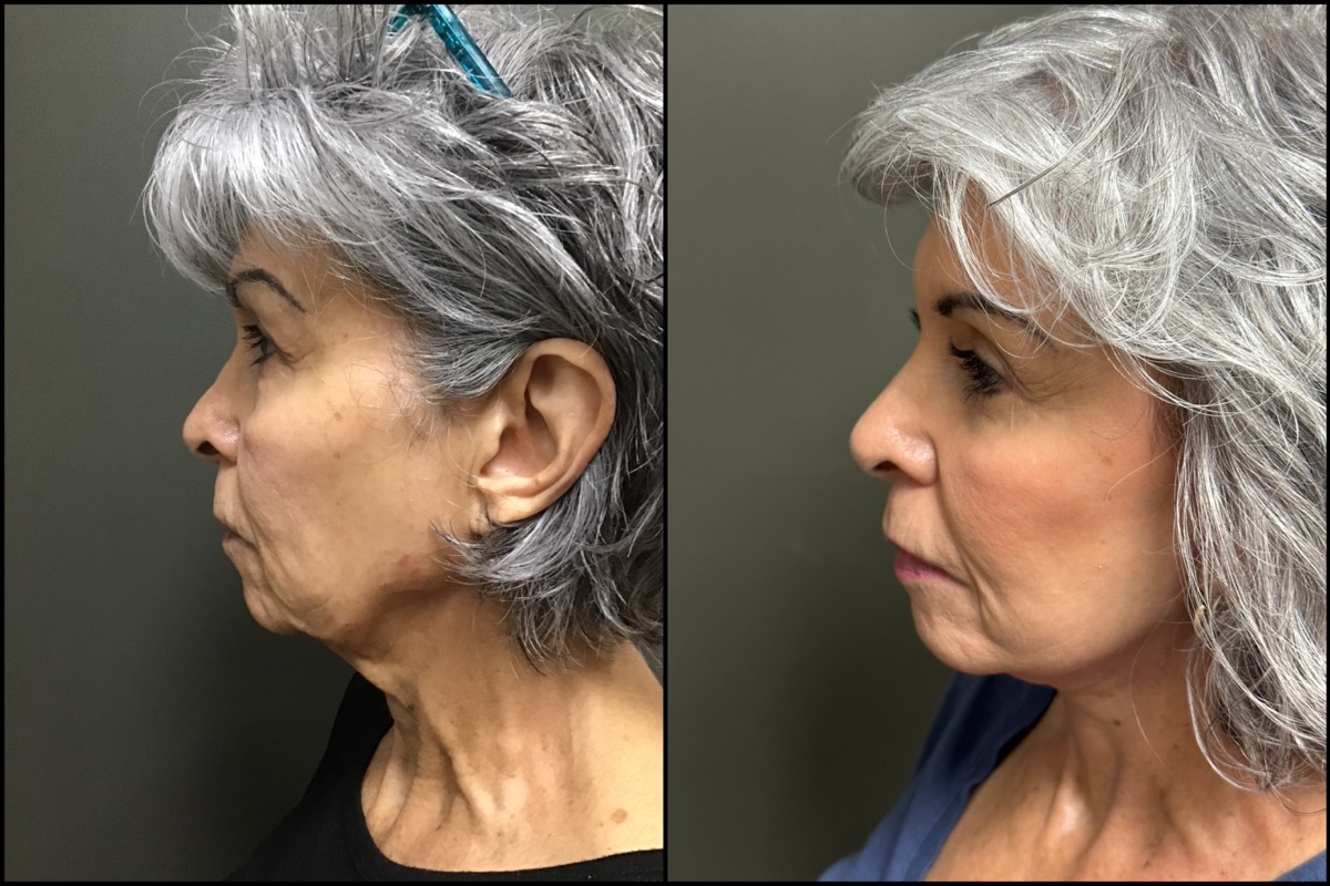 Lower Blepharoplasty - 69 Years Old 5