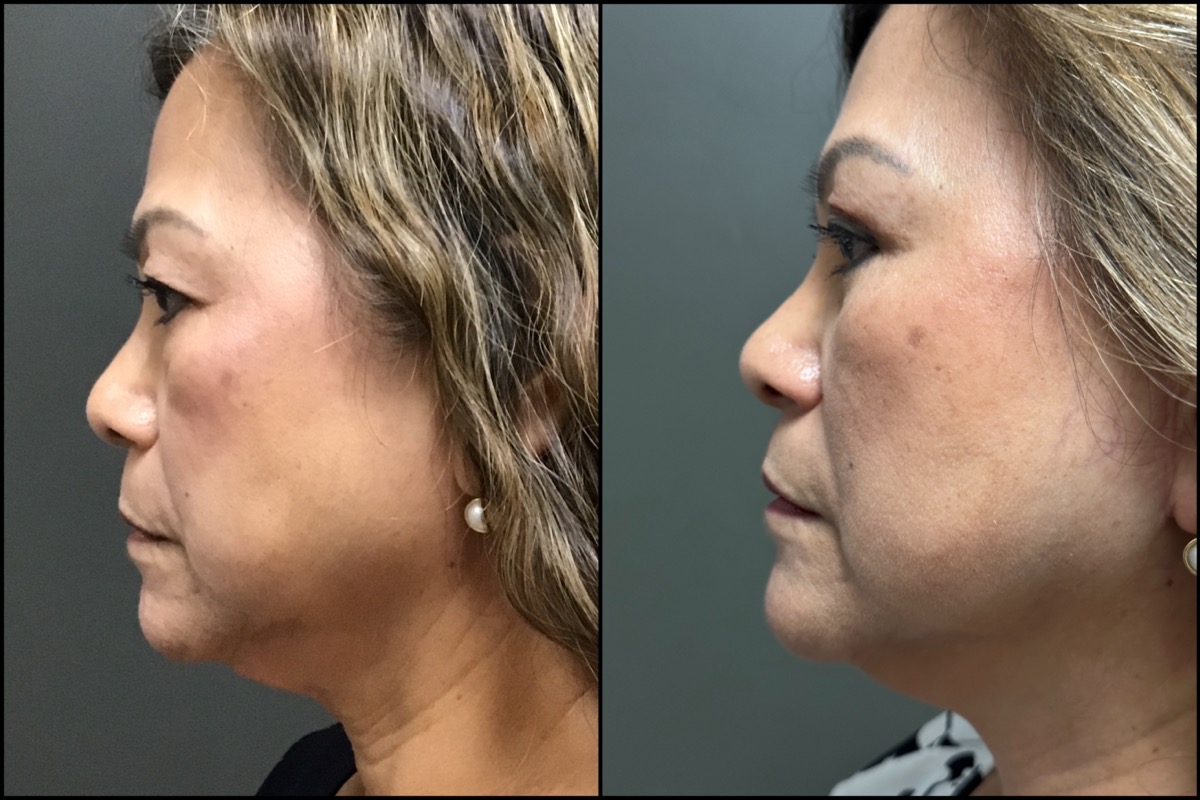 Upper and Lower Blepharoplasty - 61 Years Old 5