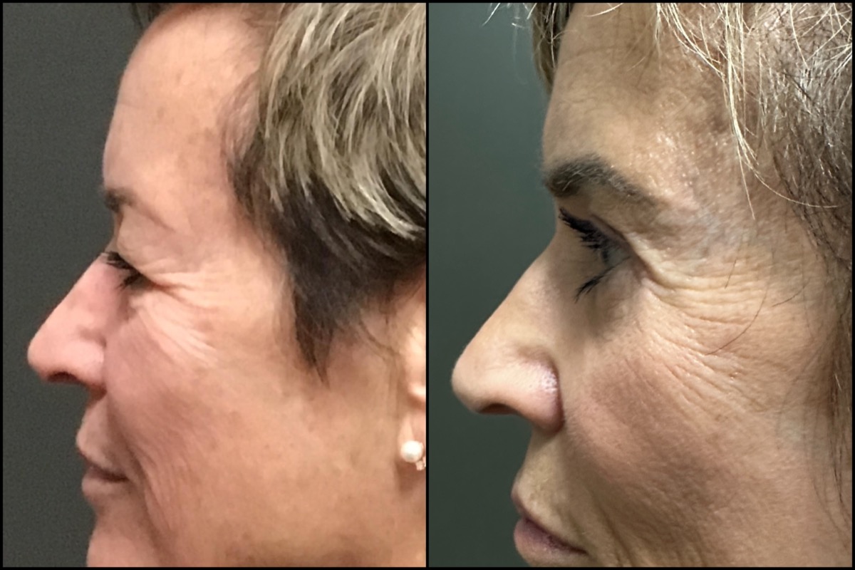 Upper and Lower Blepharoplasty - 65 Years Old 5