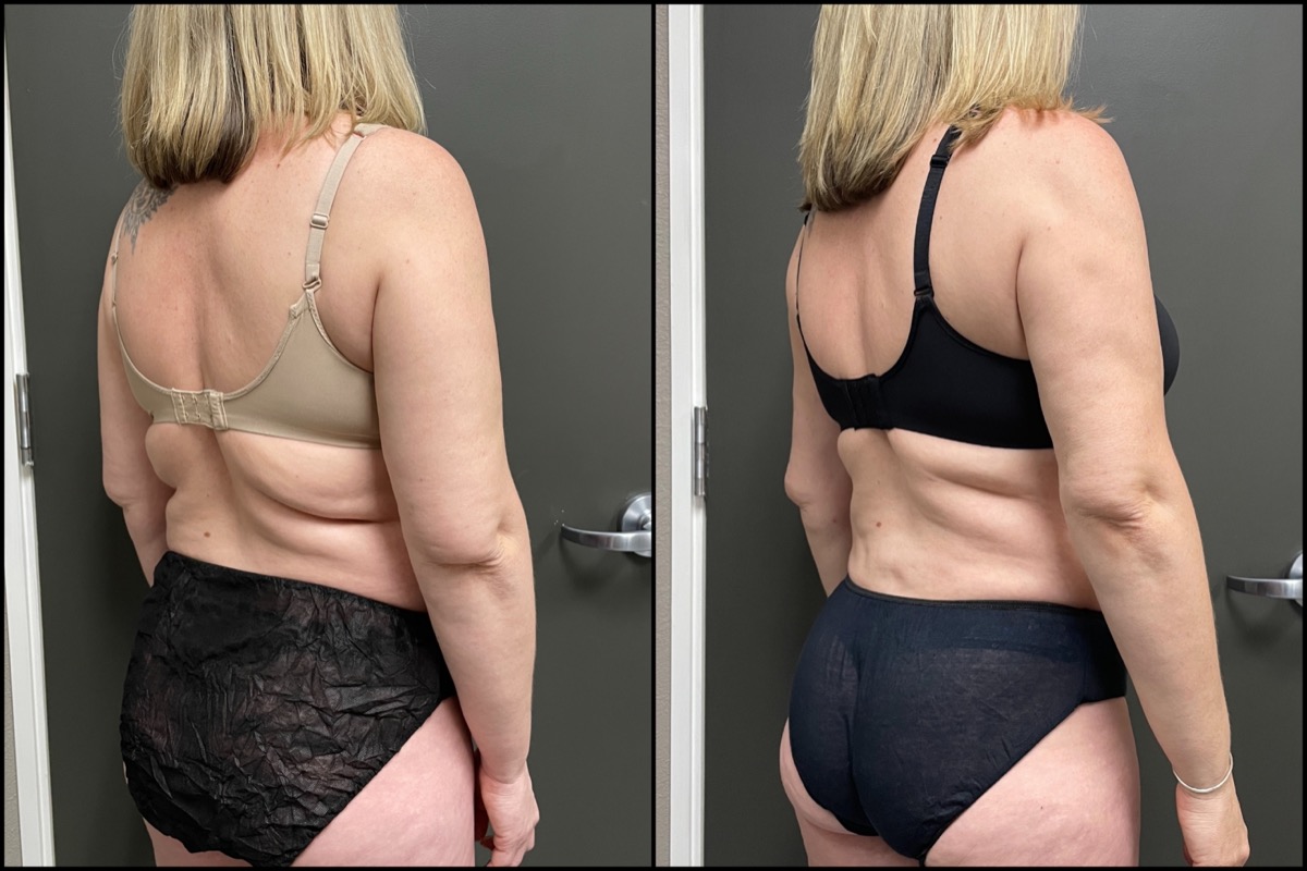 Liposuction - Arms, Back, Flanks - 46 Years Old 1