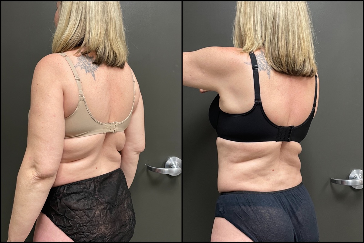 Liposuction - Arms, Back, Flanks - 46 Years Old 3