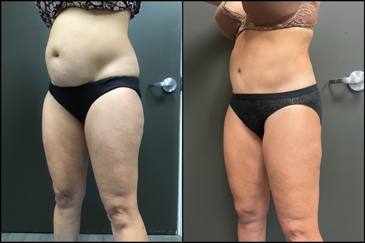Liposuction - Medial and Lateral Thigh - 47 Years Old 5