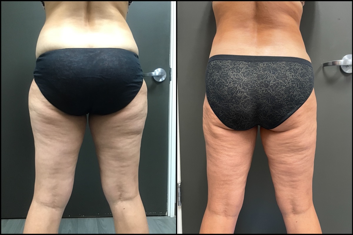 Liposuction - Medial and Lateral Thigh - 47 Years Old 6