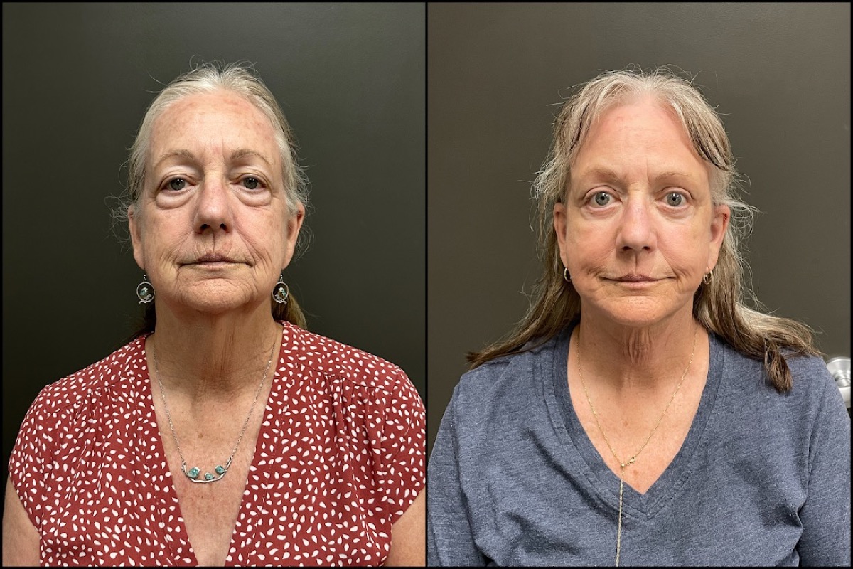 Facelift, Laser Resurfacing, Upper and Lower Blepharoplasty - 71 Years Old 1