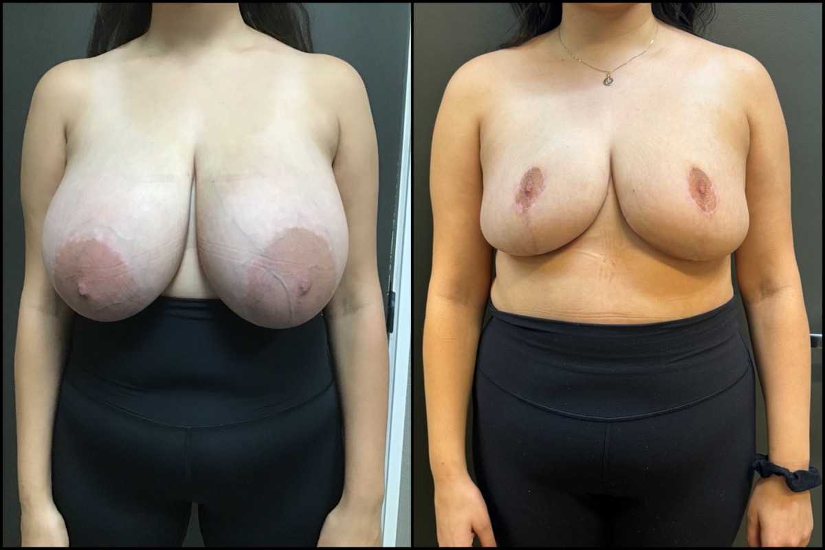 Breast Reduction - H Cup to C Cup - 28 Years Old 1