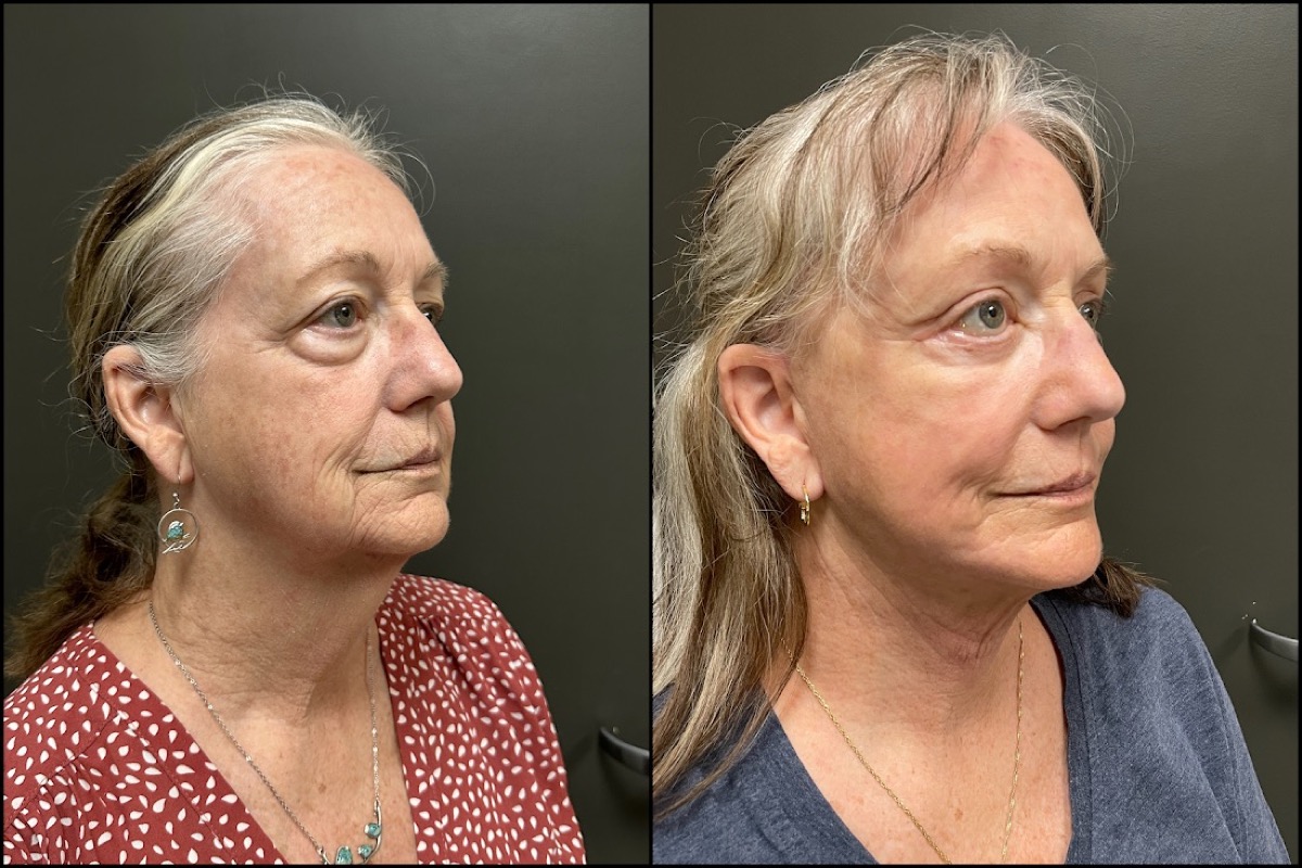 Facelift, Laser Resurfacing, Upper and Lower Blepharoplasty - 71 Years Old 2