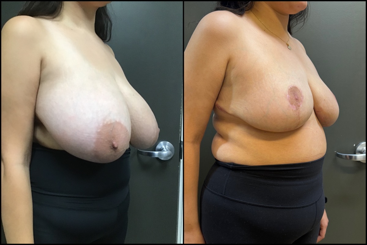 Breast Reduction - H Cup to C Cup - 28 Years Old 2