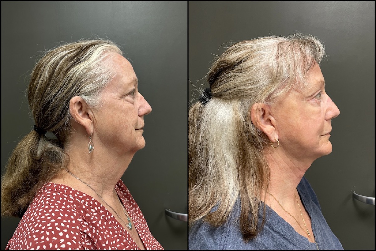 Upper and Lower Blepharoplasty, Laser Resurfacing, and Facelift - 71 Years Old 3