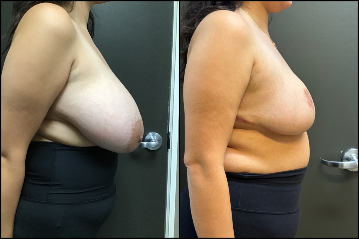 Breast Reduction - H Cup to C Cup - 28 Years Old 3