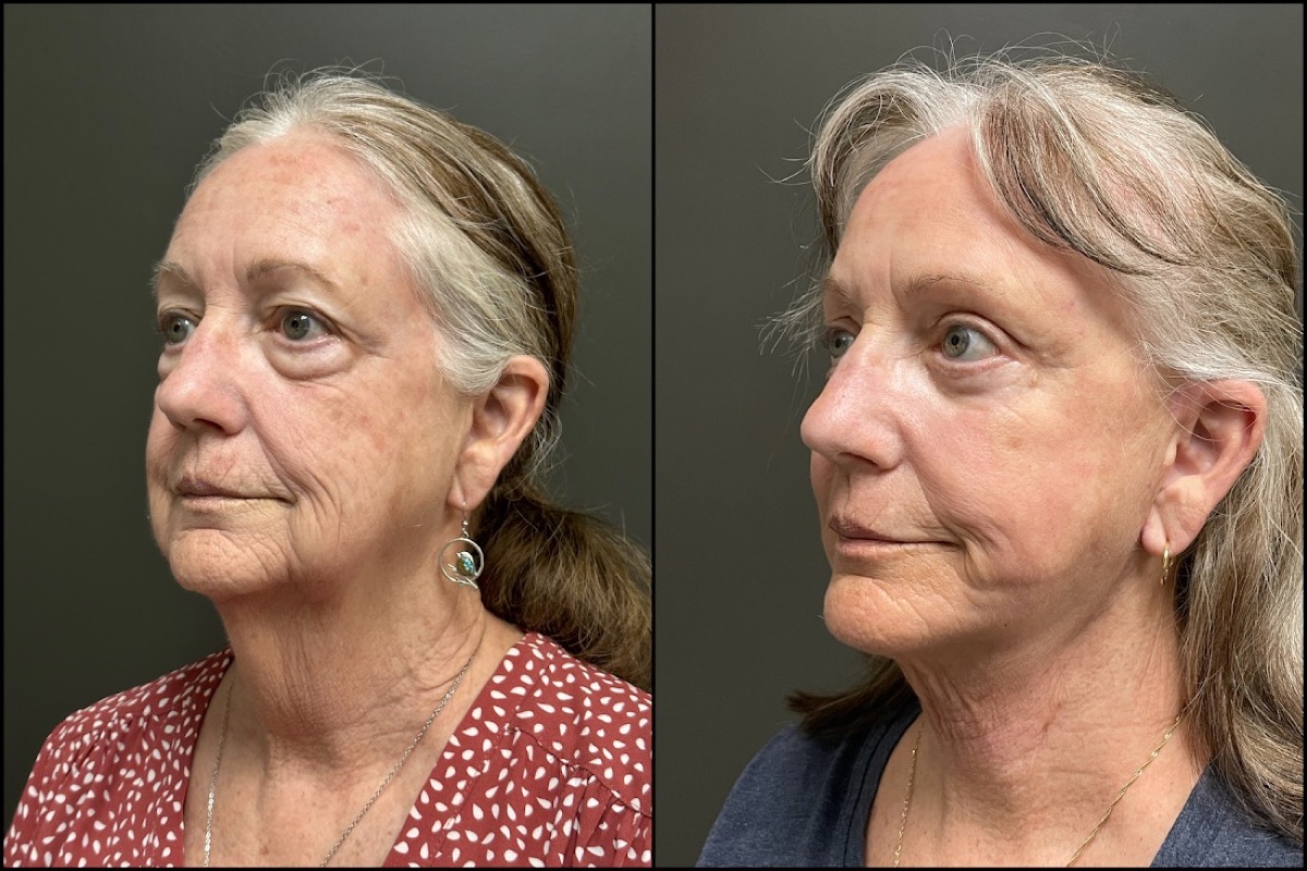 Upper and Lower Blepharoplasty, Laser Resurfacing, and Facelift - 71 Years Old 4