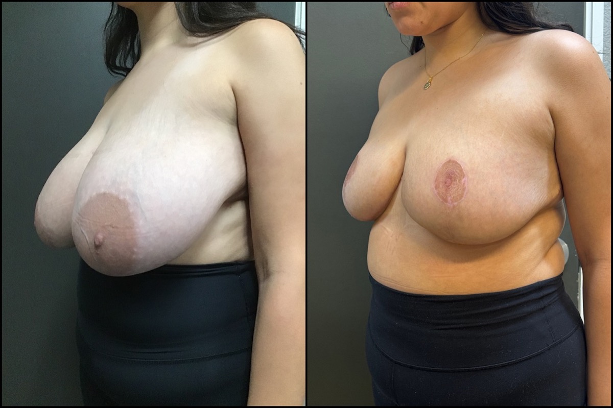 Breast Reduction - H Cup to C Cup - 28 Years Old 4
