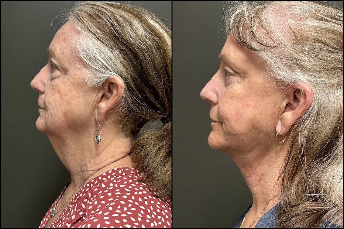 Upper and Lower Blepharoplasty, Laser Resurfacing, and Facelift - 71 Years Old 5