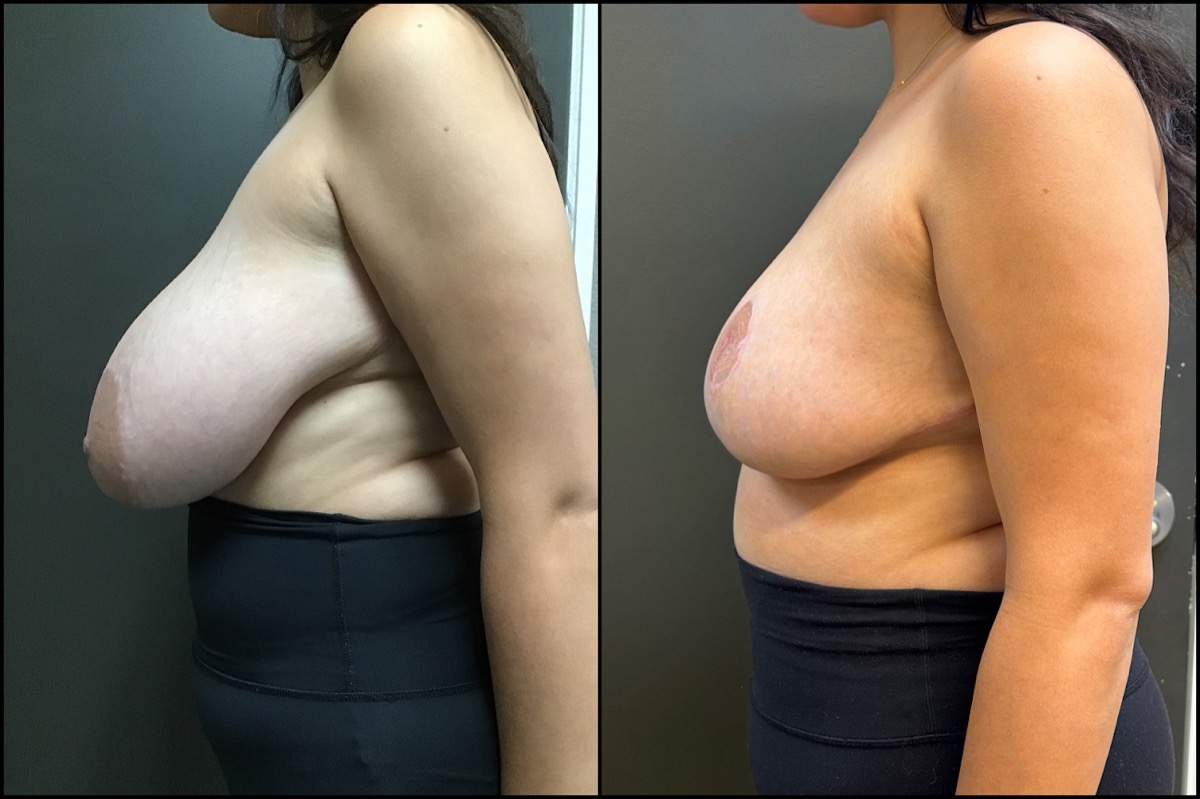 Breast Reduction - H Cup to C Cup - 28 Years Old 5
