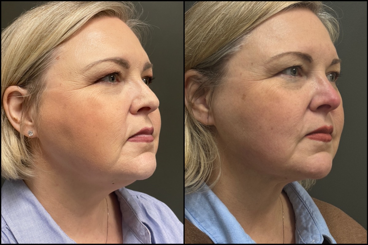Liposuction - Submental - 49 Years Old #2