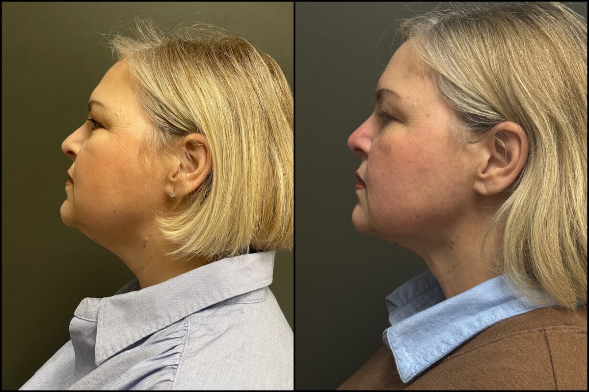 Liposuction - Submental - 49 Years Old #5