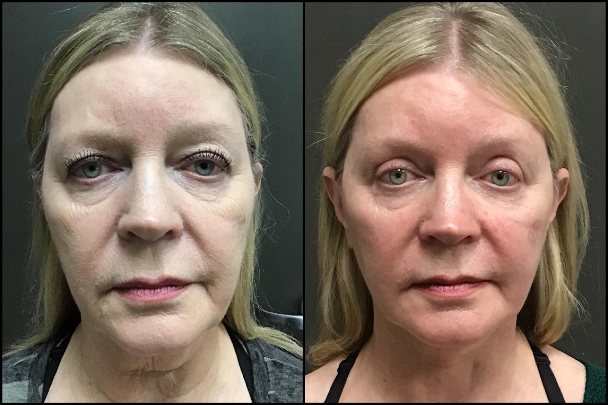 Lower Facelift & Upper Blepharoplasty - 66 Years Old 1