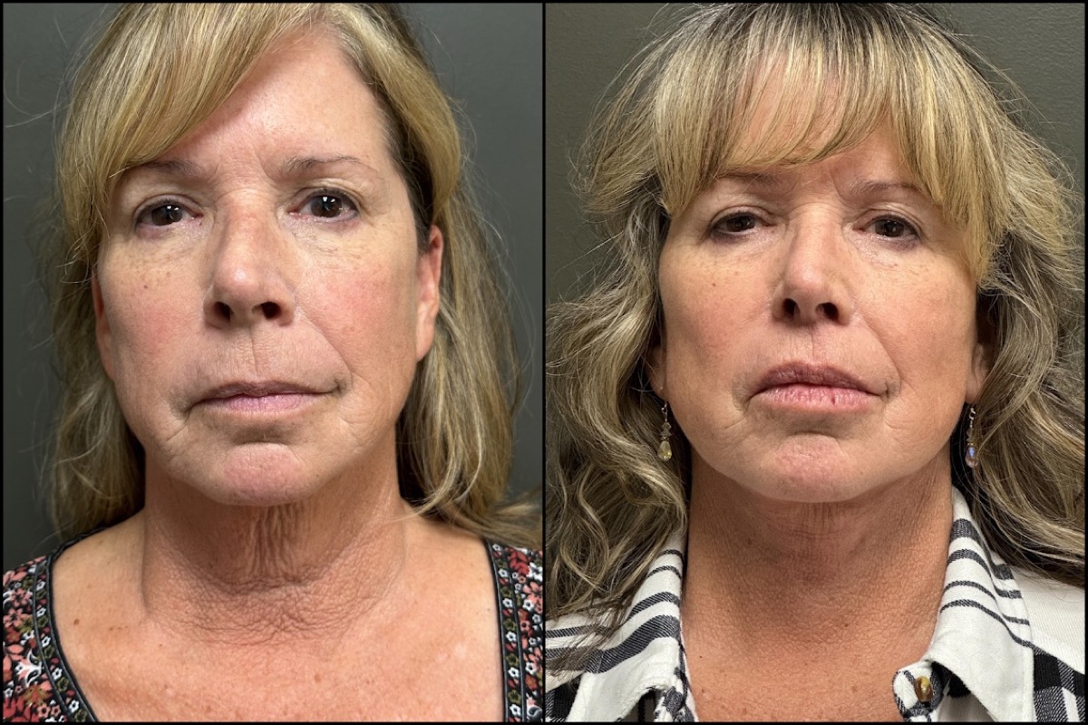Lower Facelift - 56 Years Old 1