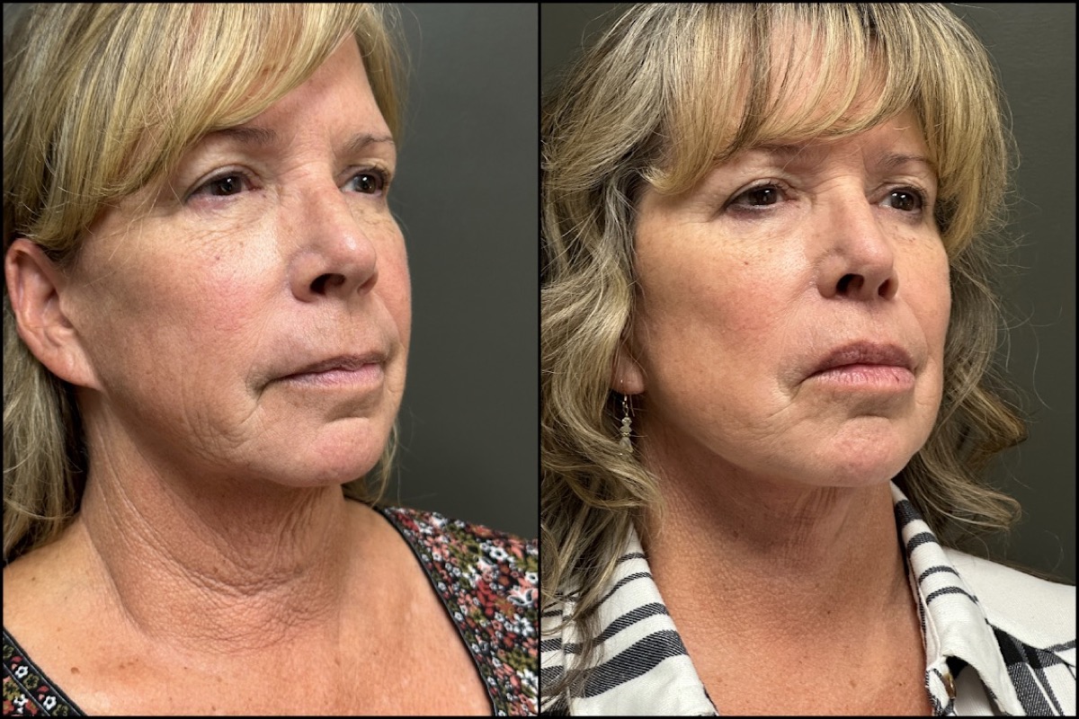 Lower Facelift - 56 Years Old 2