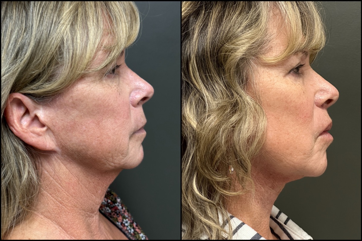 Lower Facelift - 56 Years Old 3
