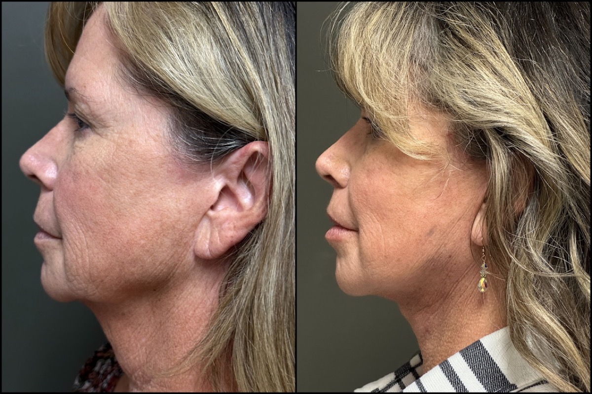 Lower Facelift - 56 Years Old 4