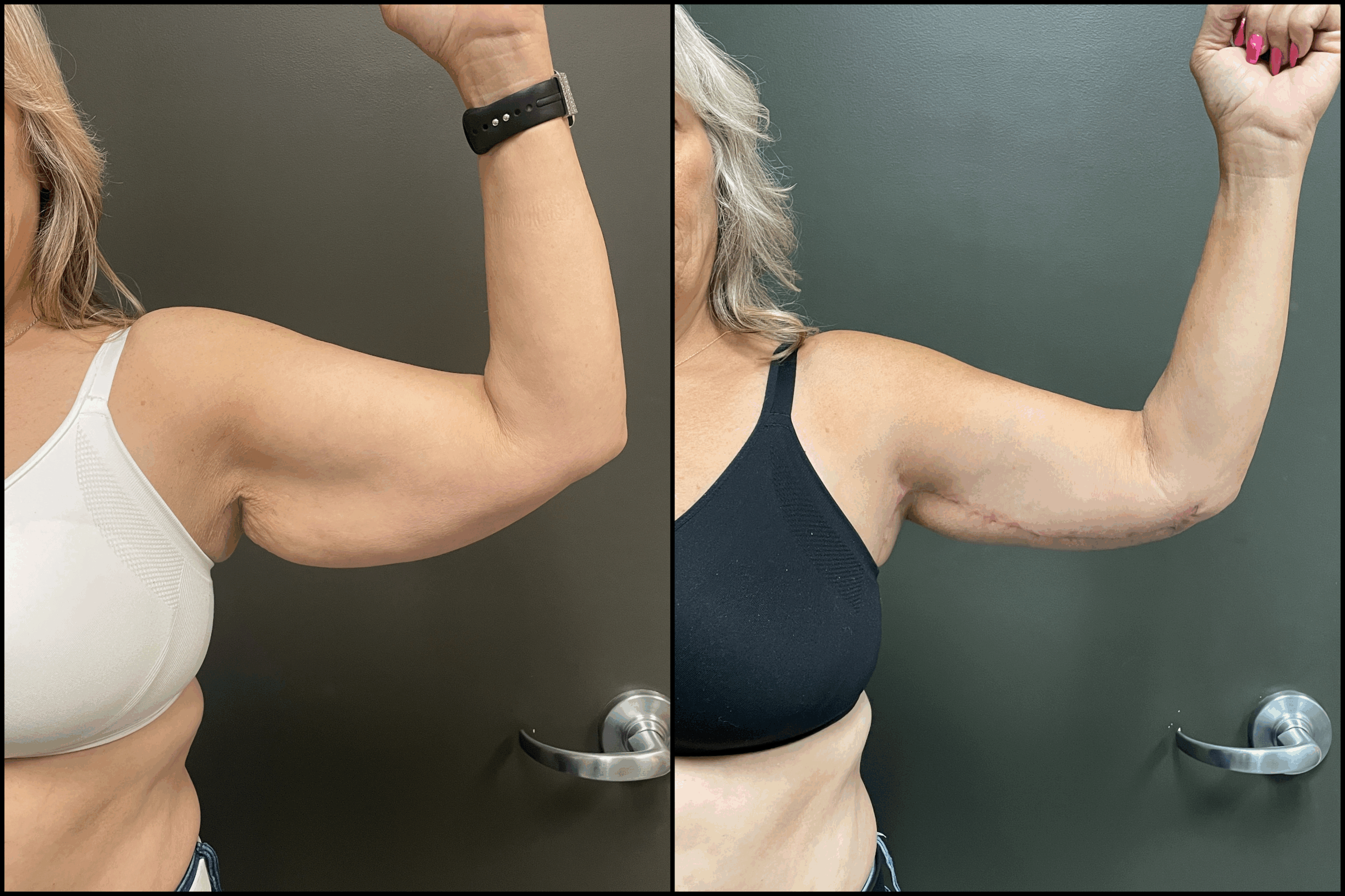 Brachioplasty