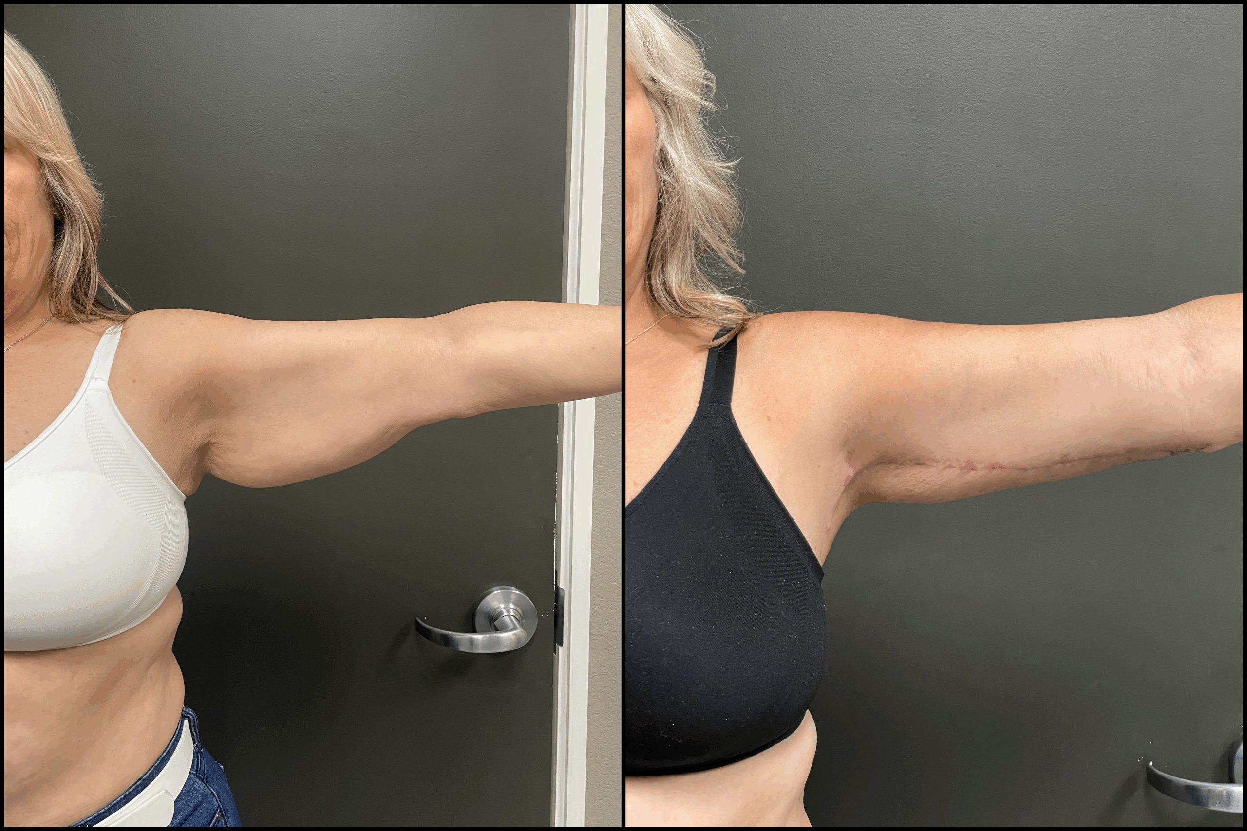 Brachioplasty