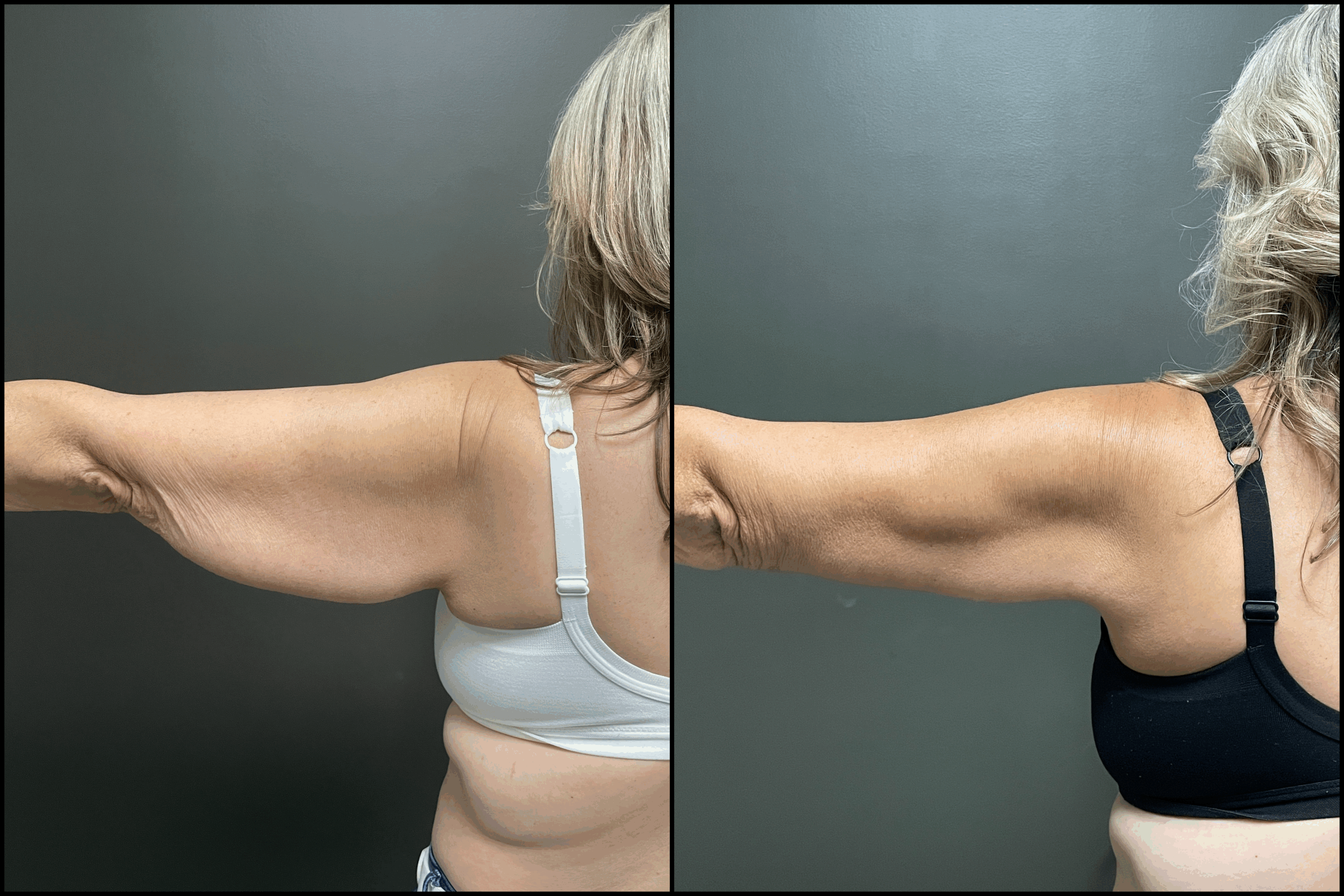 Brachioplasty
