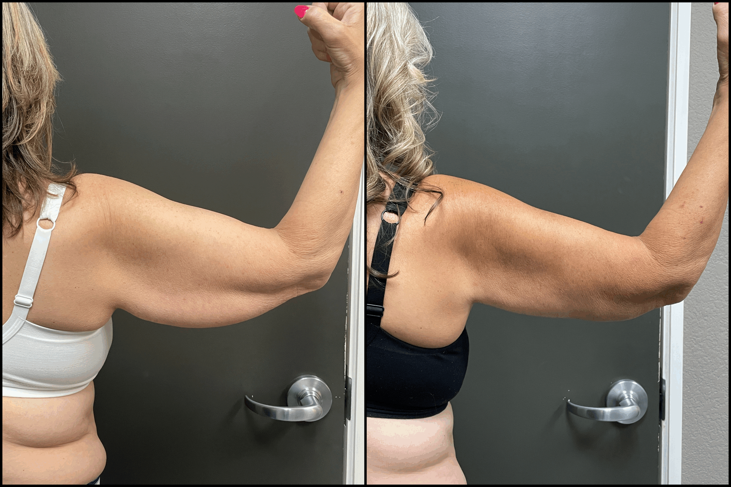 Brachioplasty