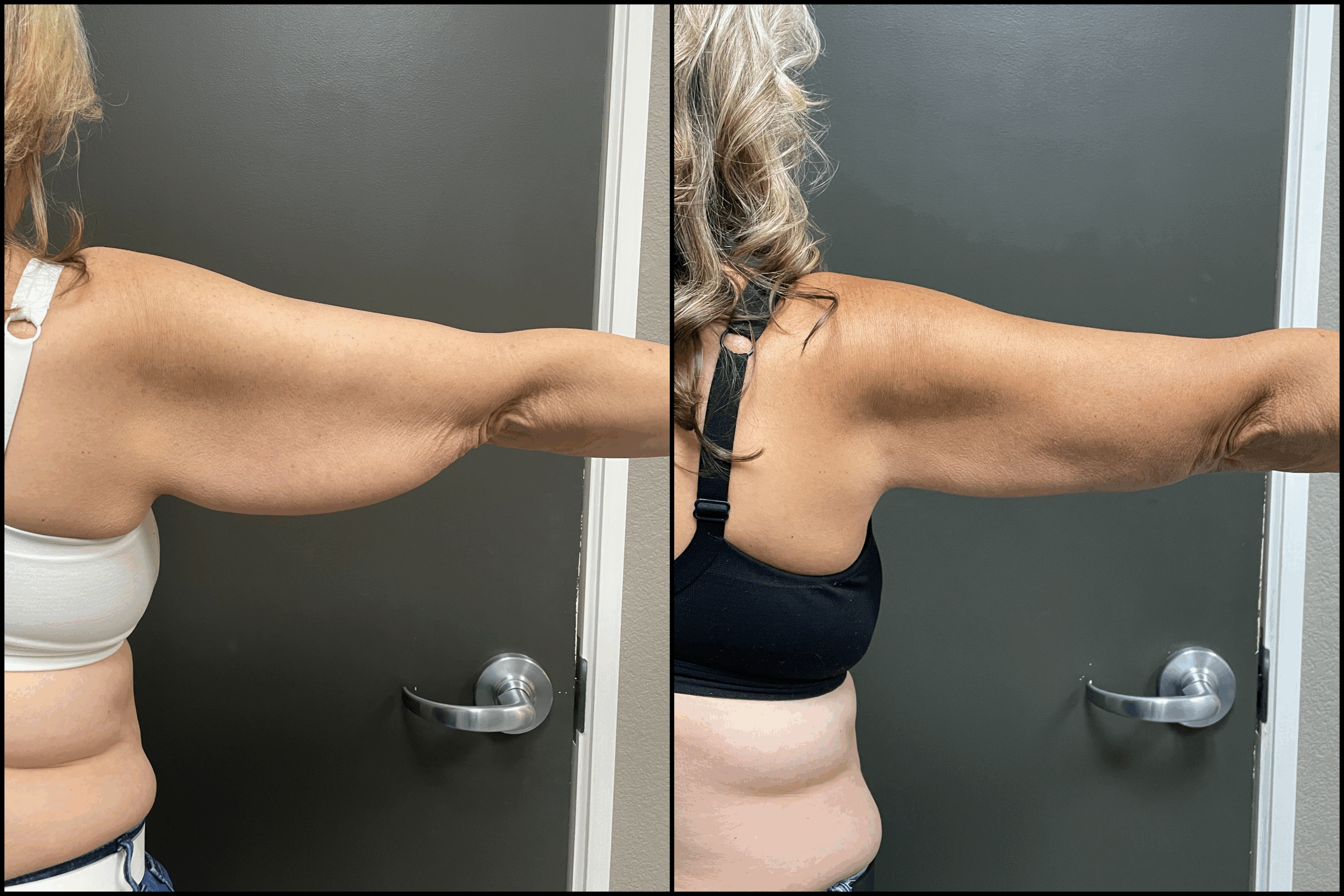 Brachioplasty