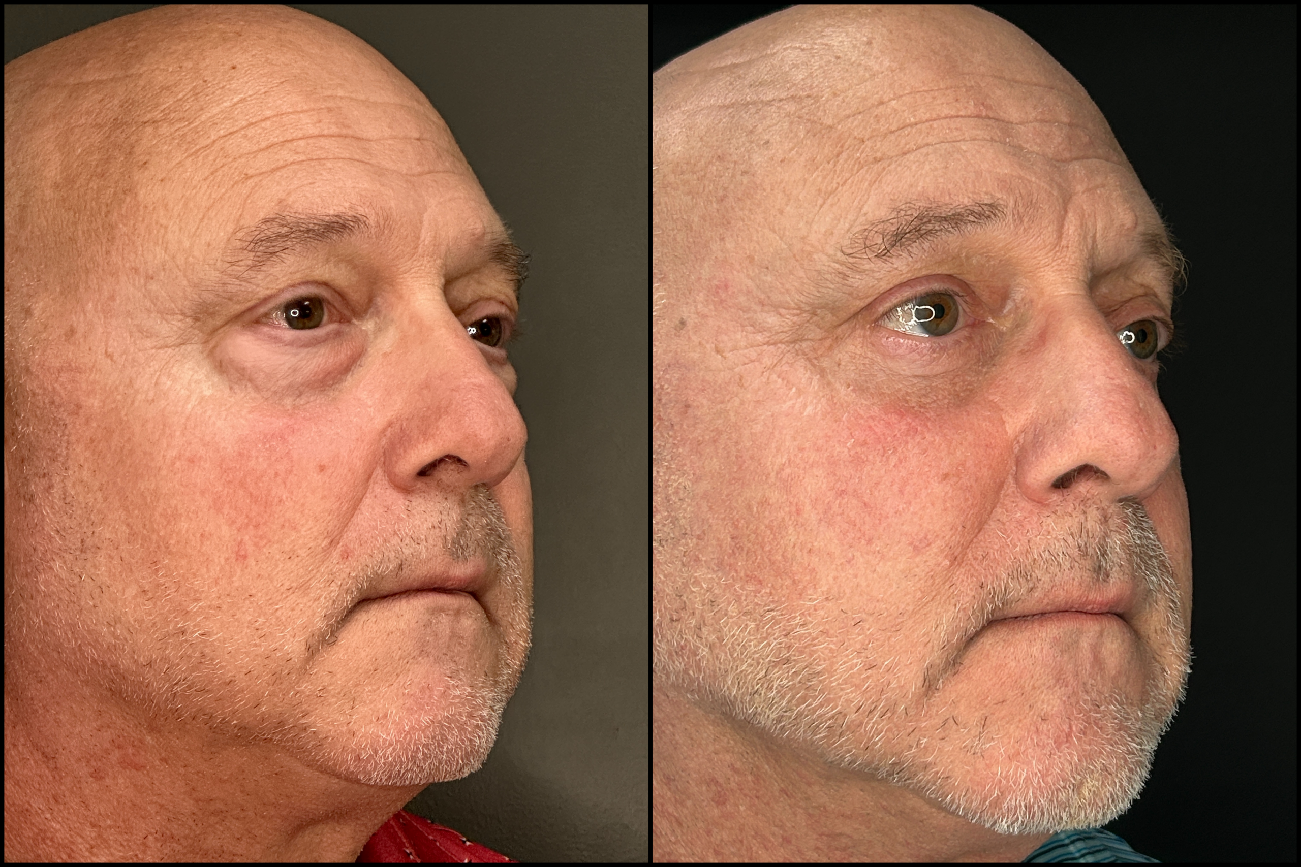 Lower Blepharoplasty - 69 Years Old Lower Blepharoplasty - 69 Years Old 1