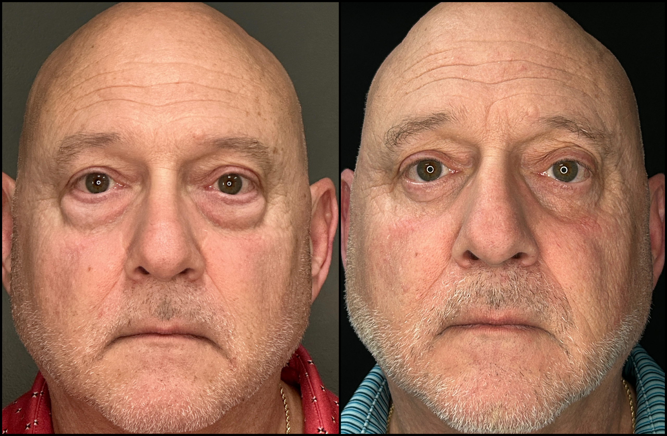 Lower Blepharoplasty - 63 Years Old Lower Blepharoplasty - 63 Years Old-1