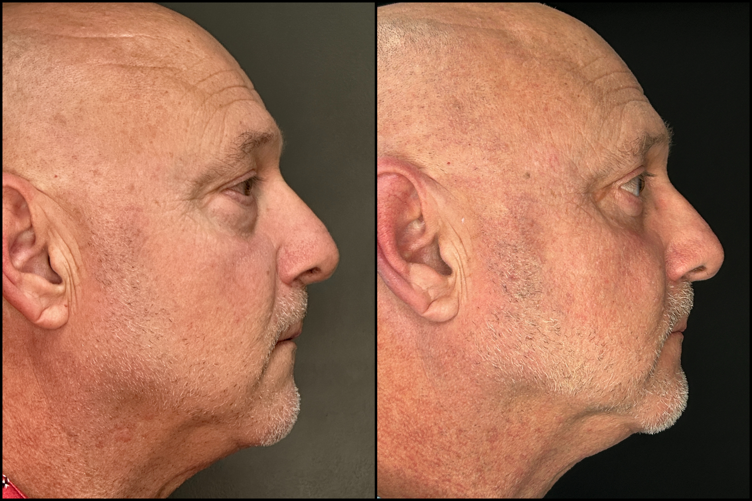 Lower Blepharoplasty - 63 Years Old - 3 Lower Blepharoplasty - 63 Years Old - 3