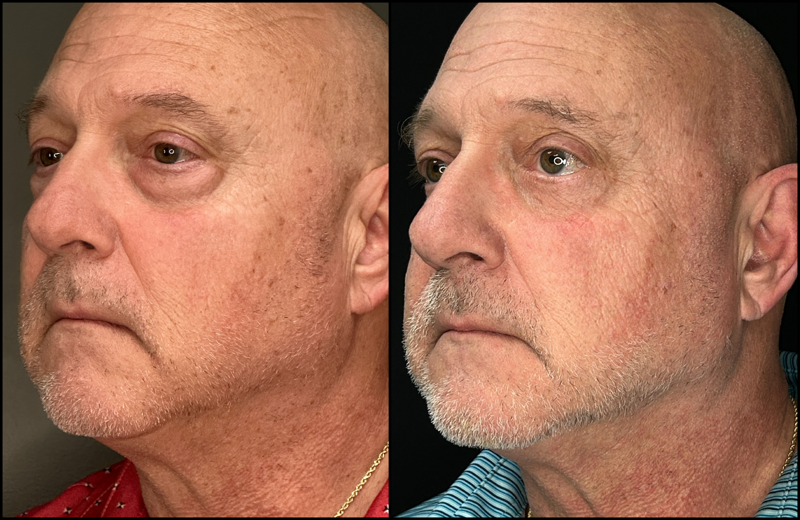 Lower Blepharoplasty - 63 Years Old -4 Lower Blepharoplasty - 63 Years Old - 4
