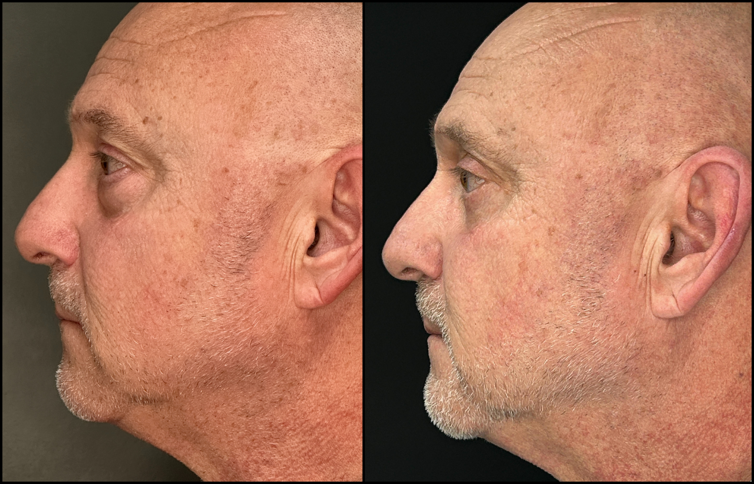 Lower Blepharoplasty - 63 Years Old - 5 Lower Blepharoplasty - 63 Years Old - 5