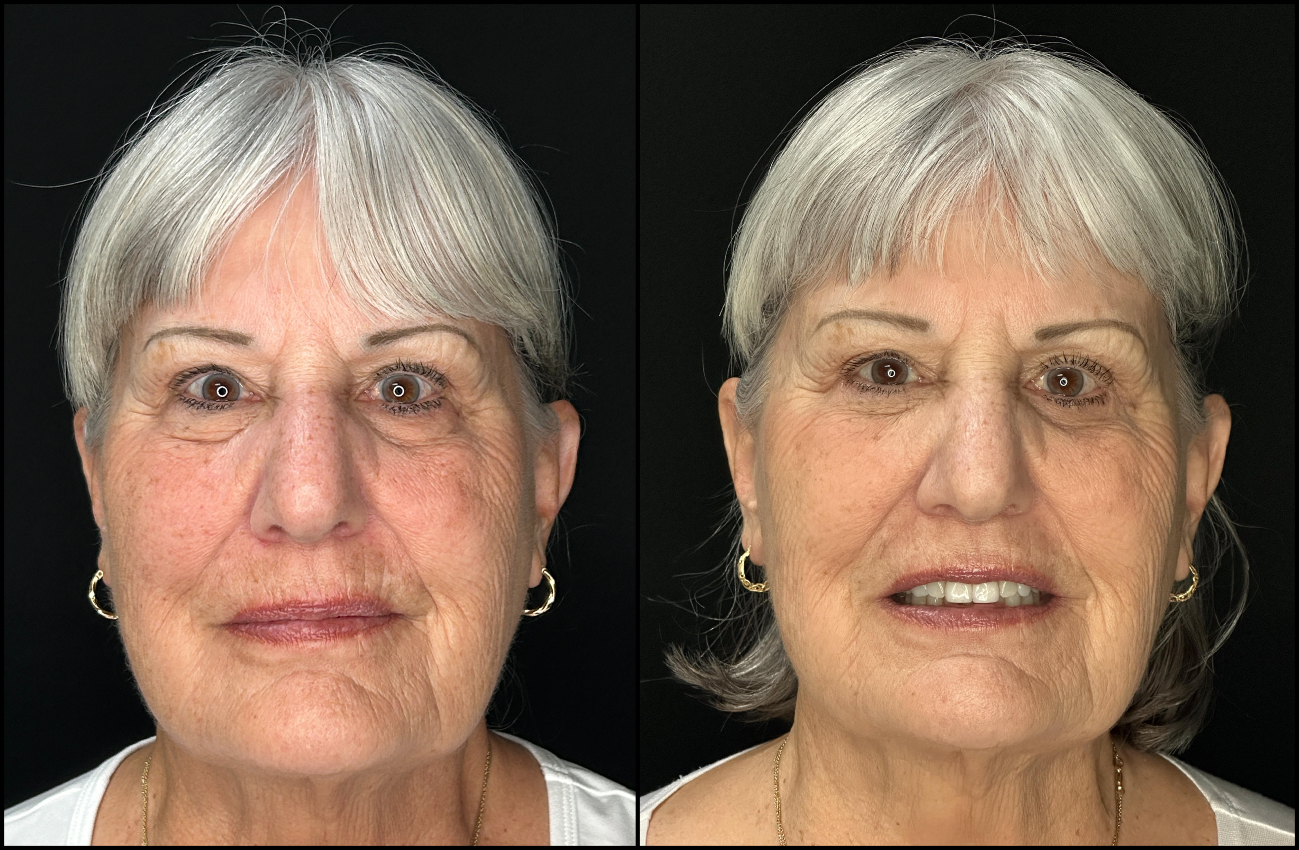 Lower Blepharoplasty - 73 Years Old-1 Lower Blepharoplasty - 73 Years Old 1