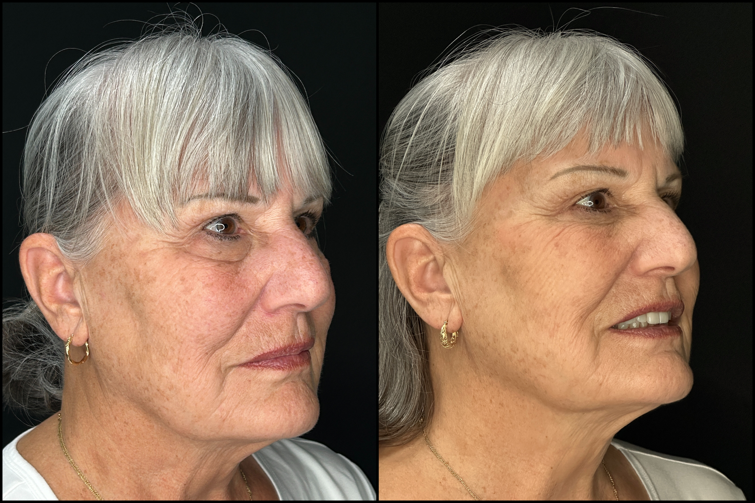 Lower Blepharoplasty - 73 Years Old -2 Lower Blepharoplasty - 73 Years Old-2