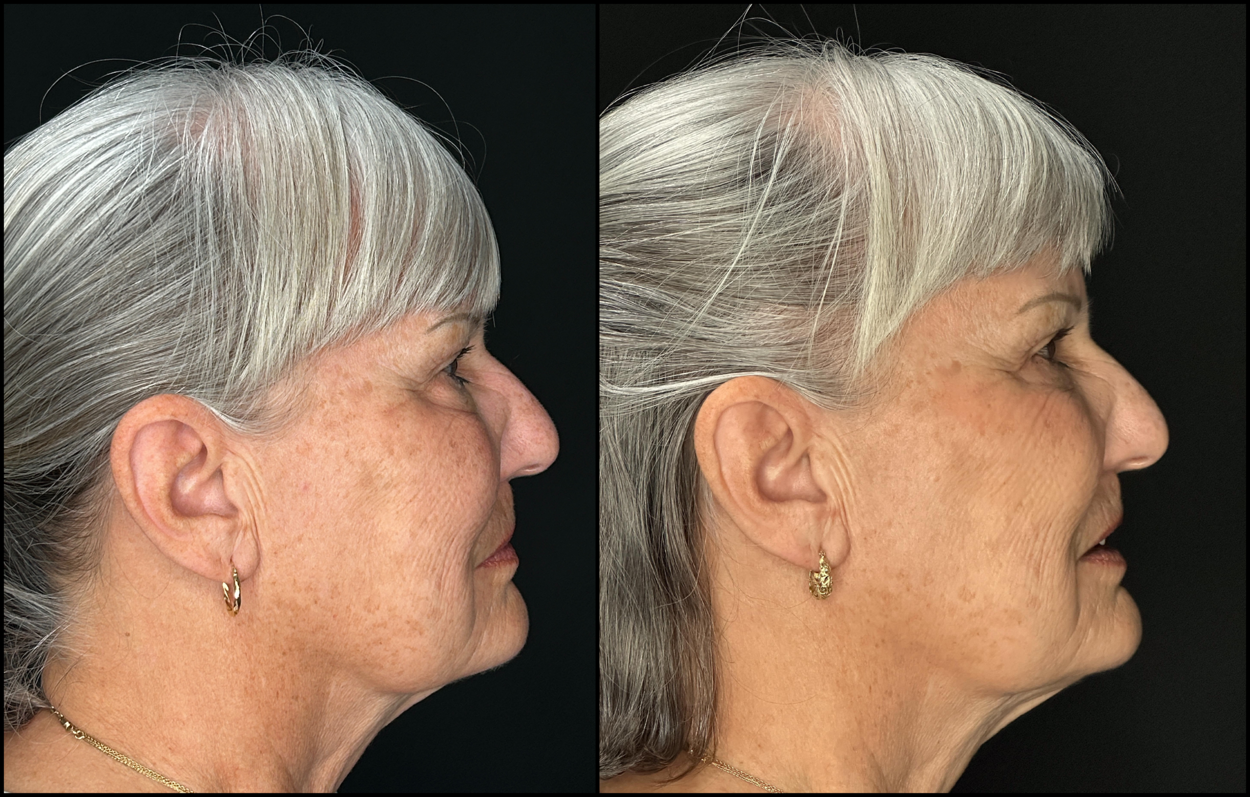 Lower Blepharoplasty - 73 Years Old - 3 Lower Blepharoplasty - 73 Years Old - 3