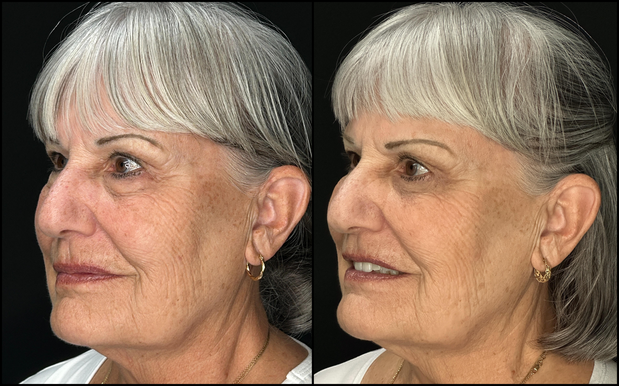 Lower Blepharoplasty - 73 Years Old -4 Lower Blepharoplasty - 73 Years Old - 4