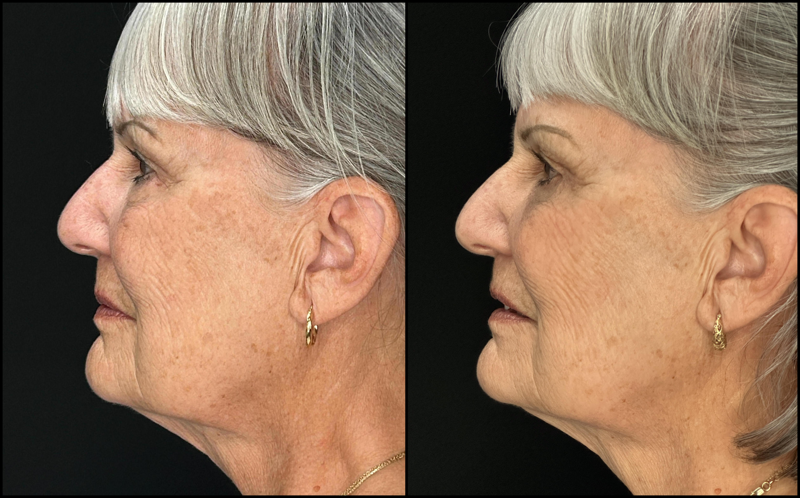 Lower Blepharoplasty - 73 Years Old - 5 Lower Blepharoplasty - 73 Years Old - 5