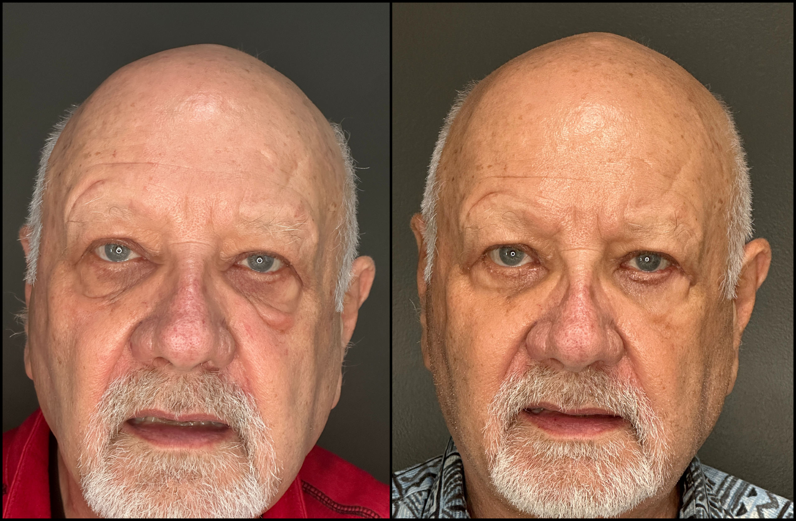 Lower Blepharoplasty - 79 Years Old Lower Blepharoplasty - 79 Years Old 1