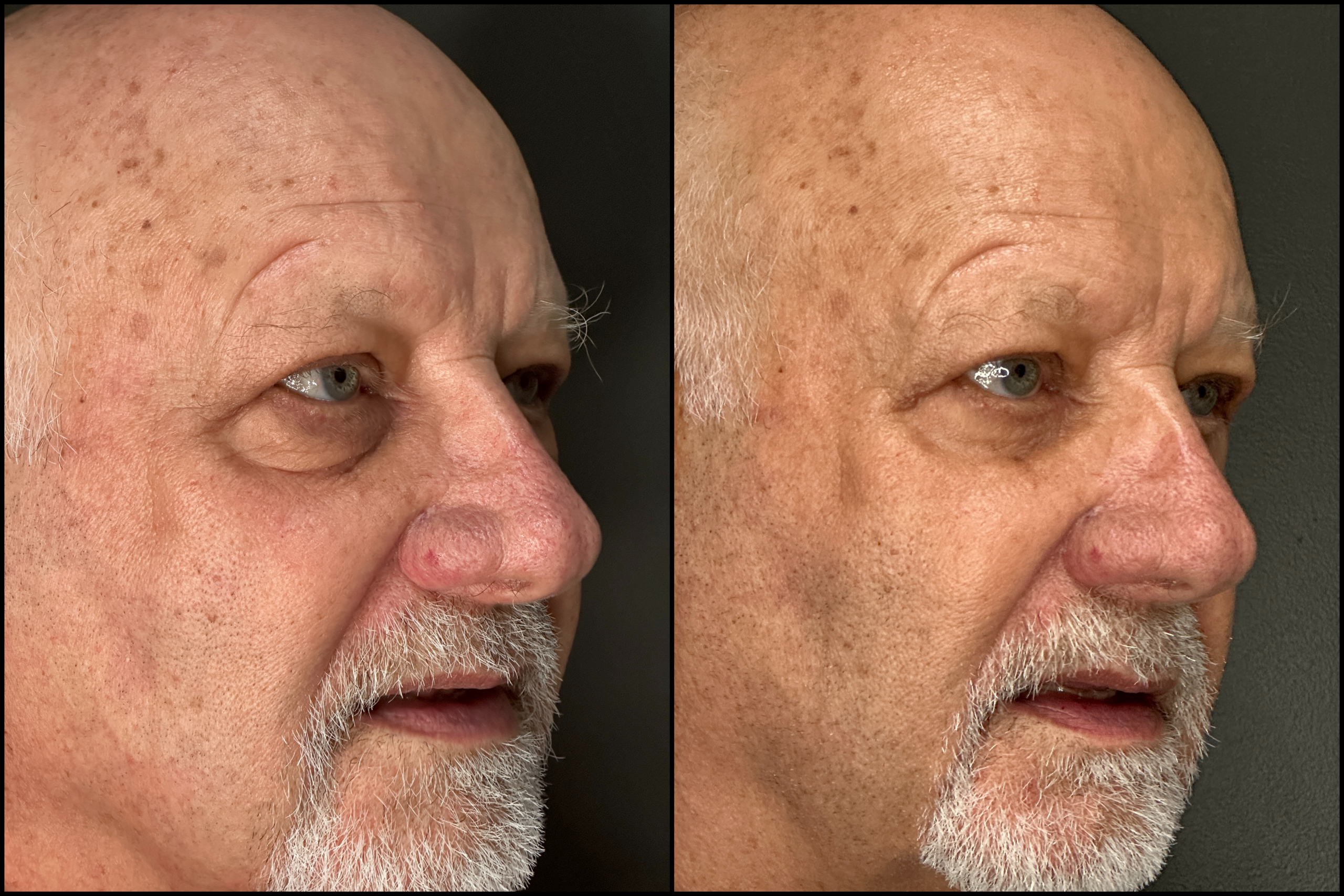 Lower Blepharoplasty - 79 Years Old Lower Blepharoplasty - 79 Years Old-1