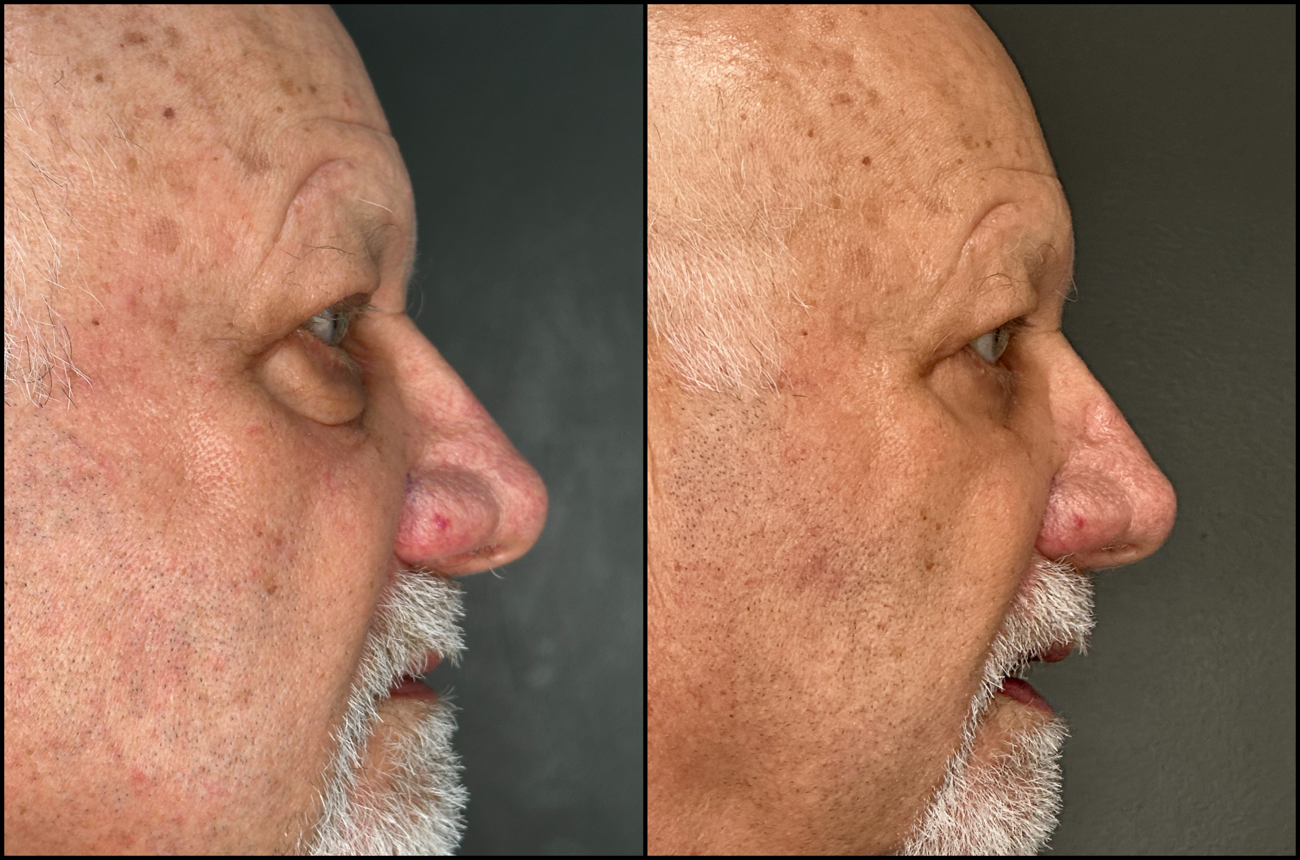 Lower Blepharoplasty - 79 Years Old - 3 Lower Blepharoplasty - 79 Years Old - 3