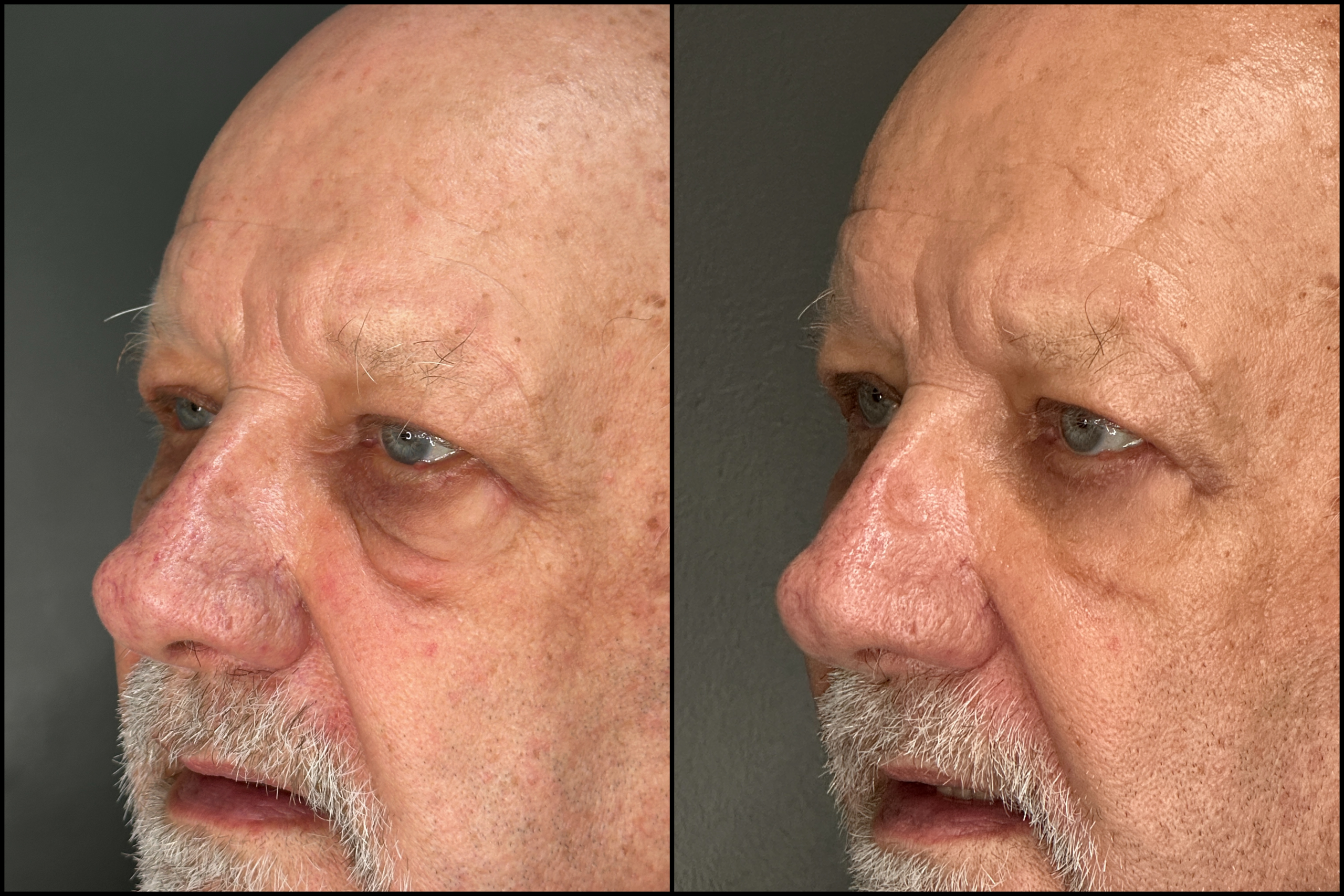 Lower Blepharoplasty - 79 Years Old -4 Lower Blepharoplasty - 79 Years Old - 4