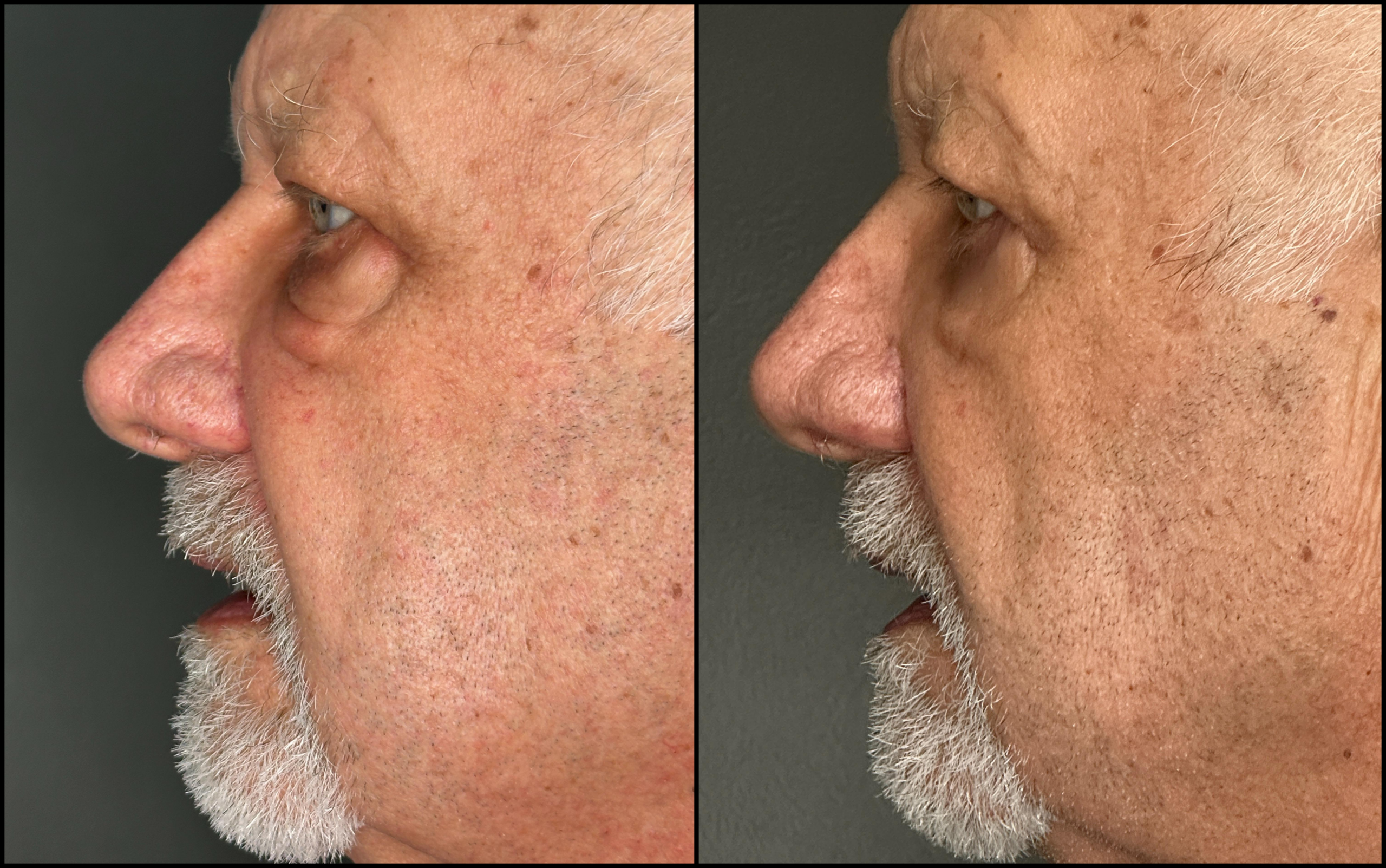 Lower Blepharoplasty - 79 Years Old - 5 Lower Blepharoplasty - 79 Years Old - 5